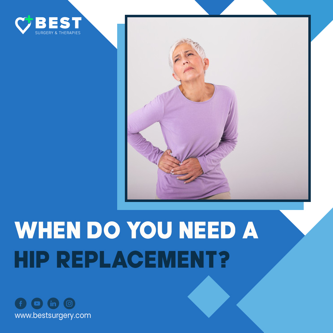 When Do You Need a Hip Replacement? | Best Surgery Center